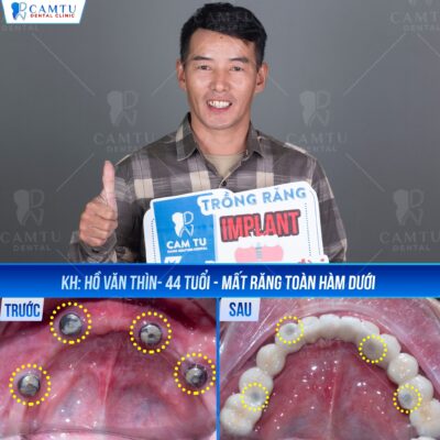 Trồng răng Implant