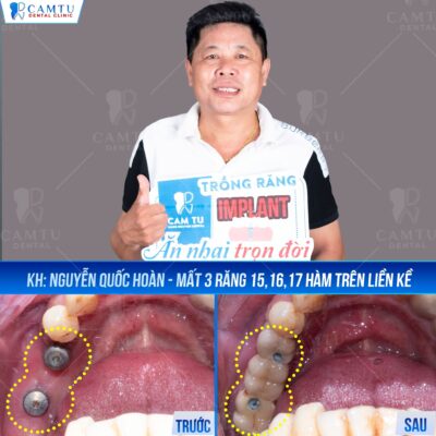 Trồng implant - lựa chọn thay thế răng mất