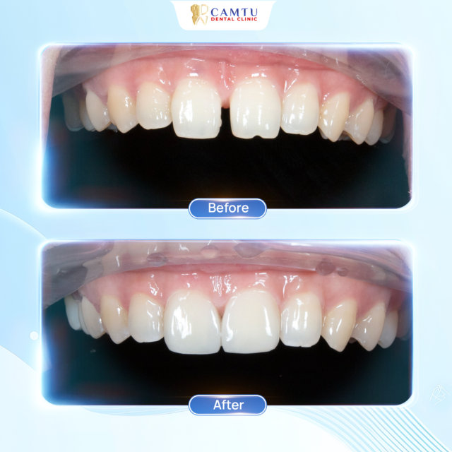 Dán sứ veneer có đau không ?- Nha khoa Cẩm Tú