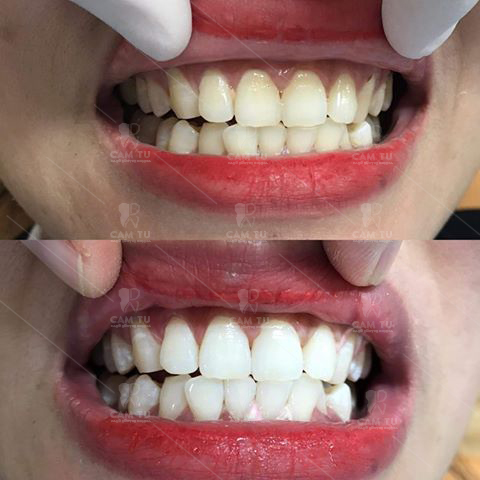 Tẩy trắng răng ố vàng tại Nha khoa Cẩm Tú