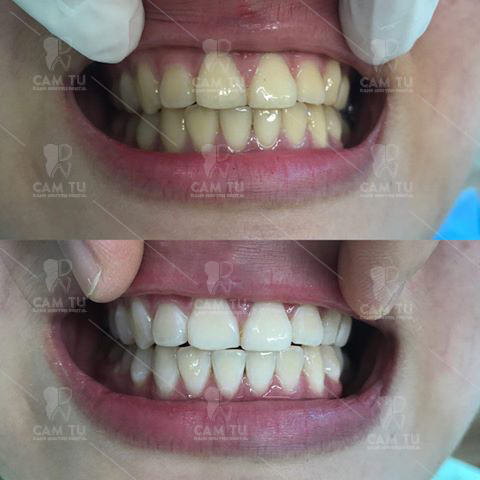 Đánh bay răng xỉn màu cùng Nha khoa Cẩm Tú