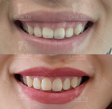 Hình ảnh khách hàng cắt lợi tại Nha khoa Cẩm Tú