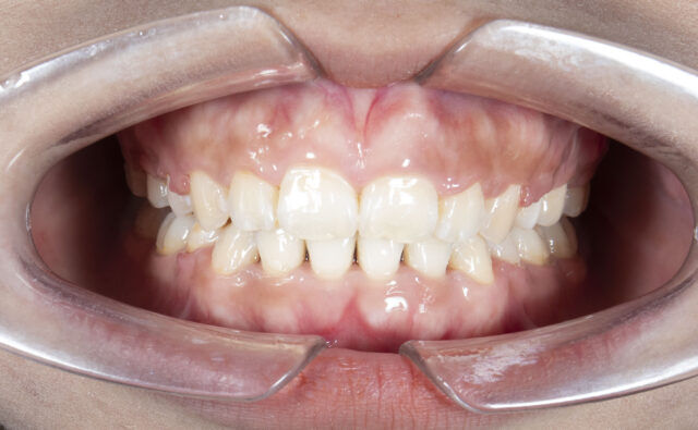 Lợi che phủ răng gây mất thẩm mỹ