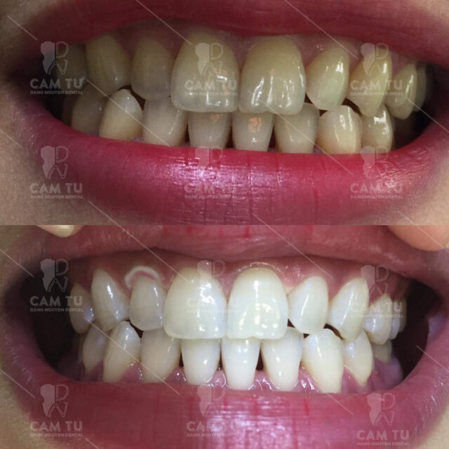 Có nên làm trắng răng không- Giải đáp cùng Nha khoa Cẩm Tú
