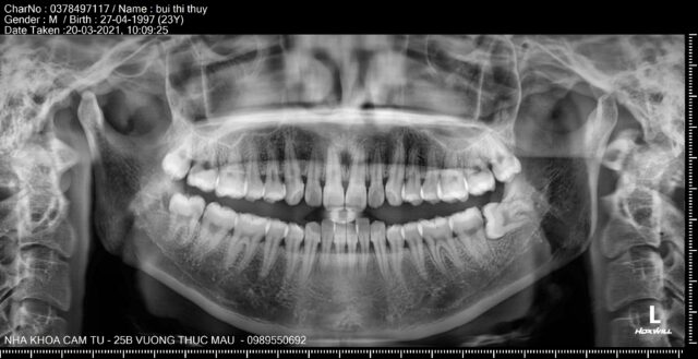 Răng khôn mọc lệch, đâm vào răng bên cạnh gây đau nhức