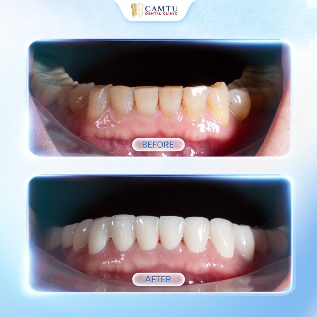 Hàm dưới trước và sau phục hình răng sứ