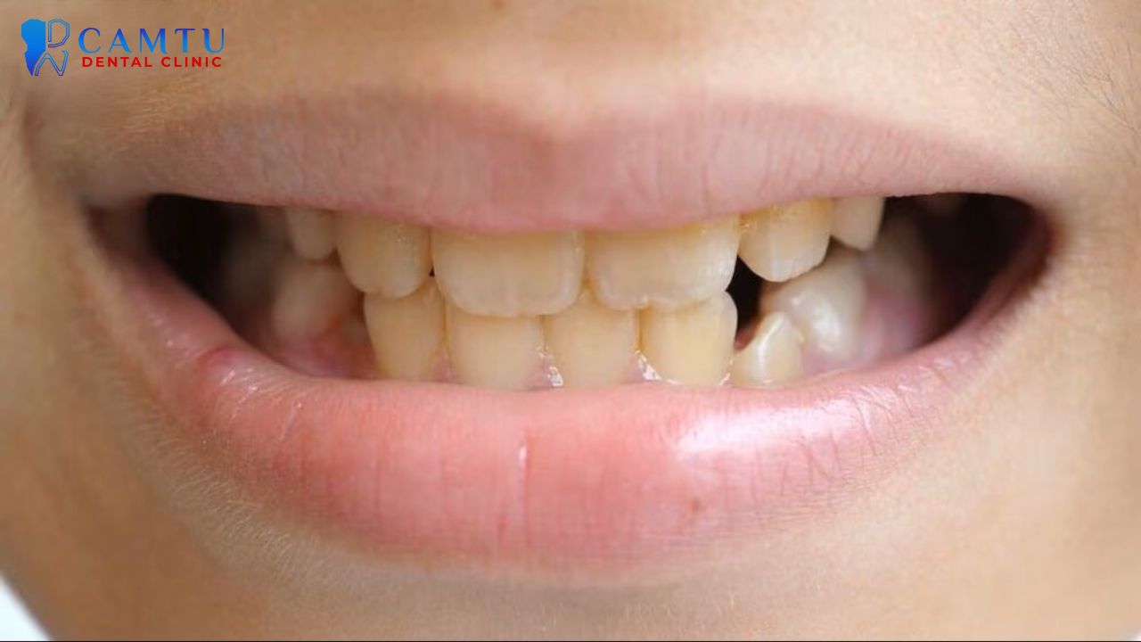 Cách làm trắng răng