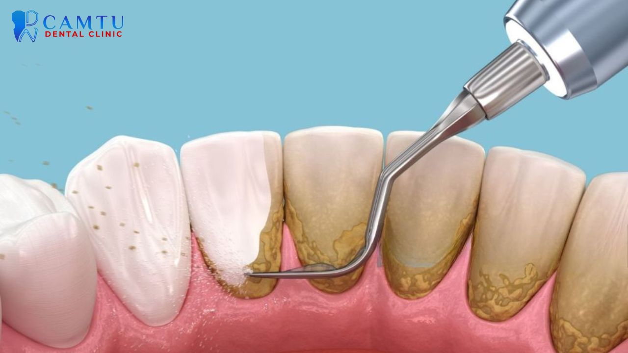 Cách làm trắng răng