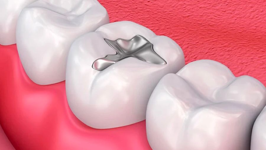 Hàn trám răng sâu