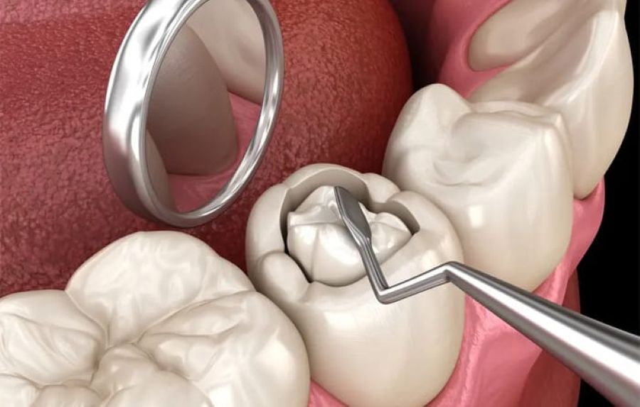 Hàn trám răng sâu