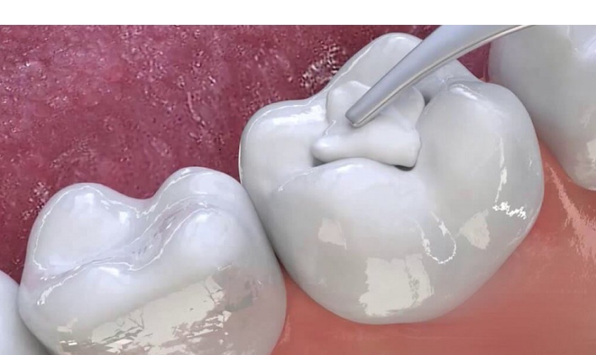 Hàn trám răng sâu