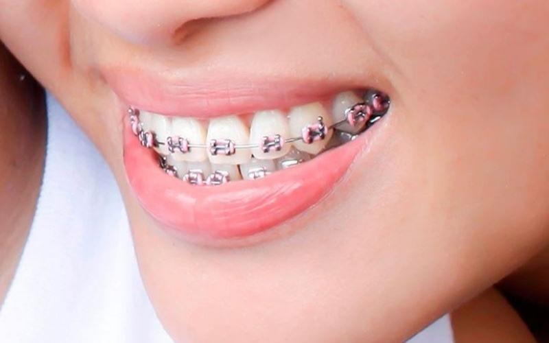 Mắc cài kim loại thường