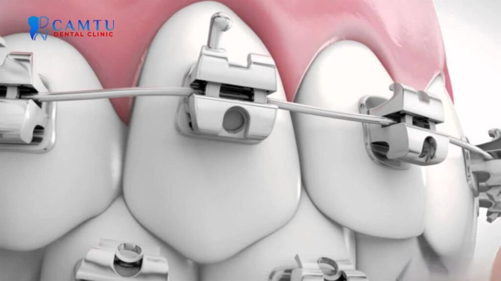 Mắc cài kim loại tự buộc