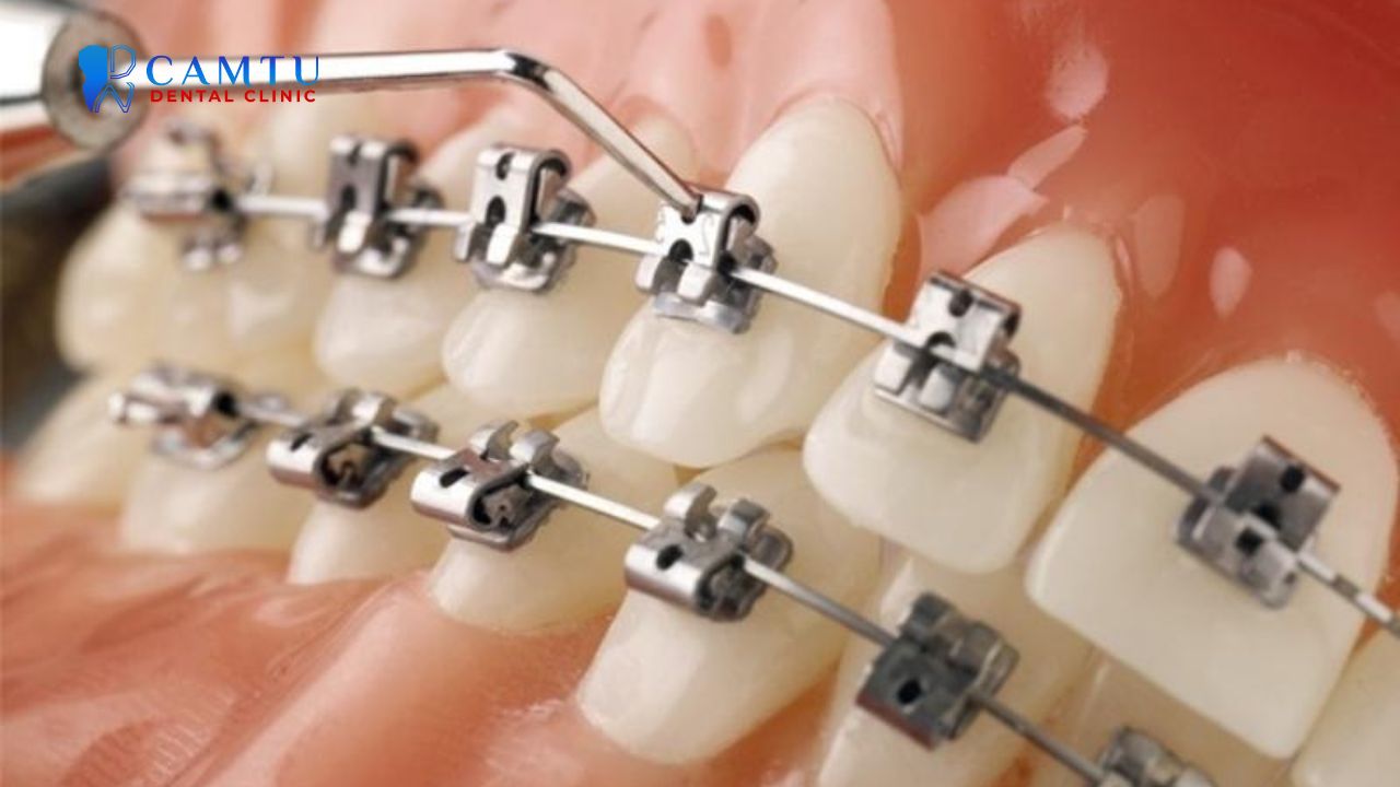 Mắc cài kim loại tự buộc