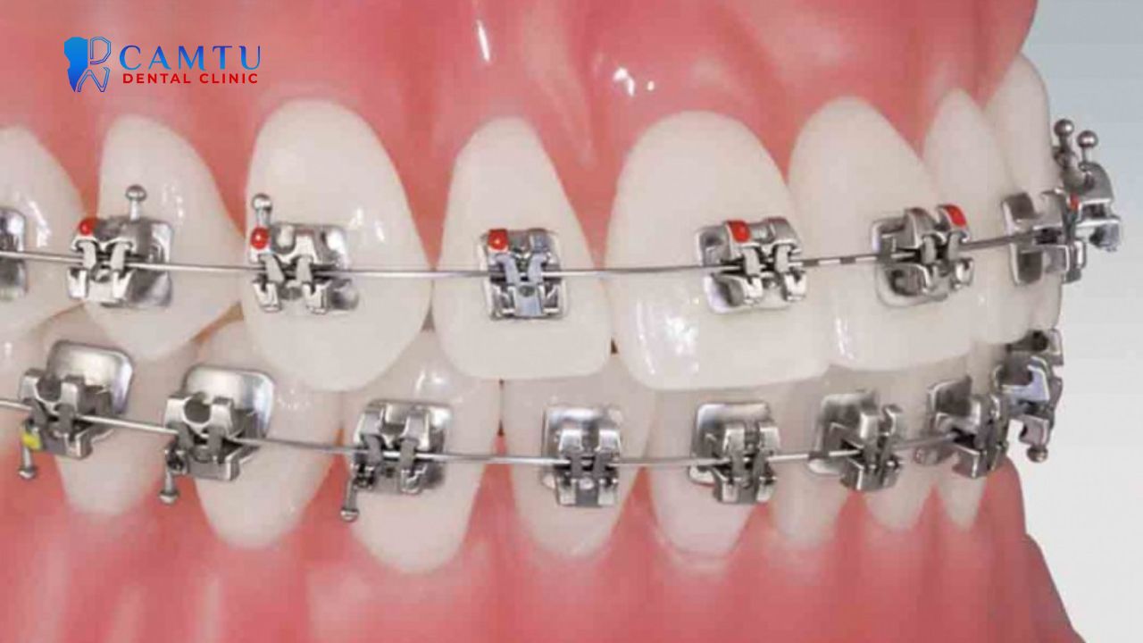 Mắc cài kim loại tự buộc