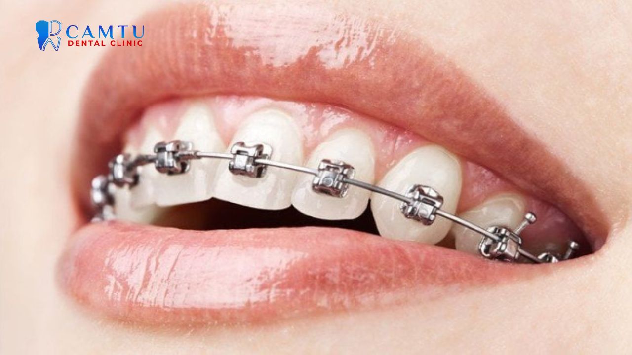 Mắc cài kim loại tự buộc