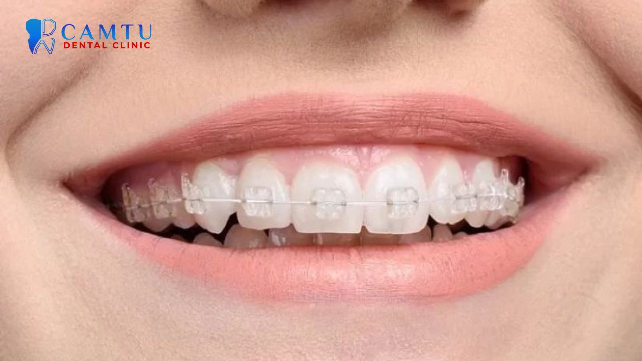 Mắc cài sứ thường