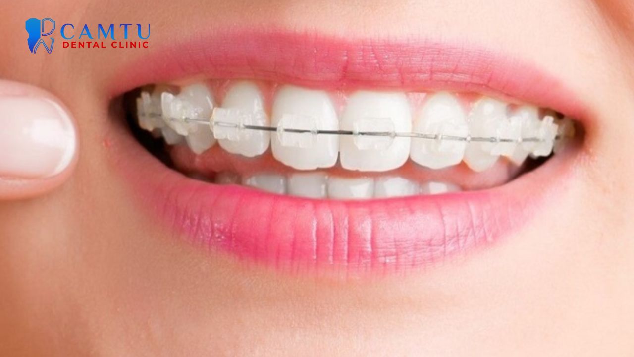 Mắc cài sứ thường