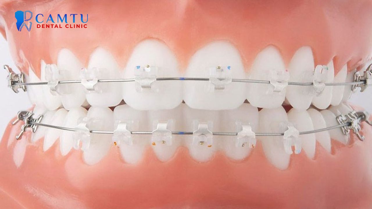 Mắc cài sứ thường