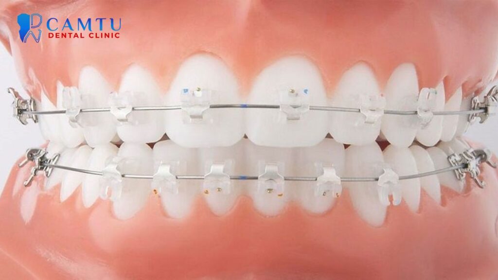 Mắc cài sứ tự buộc