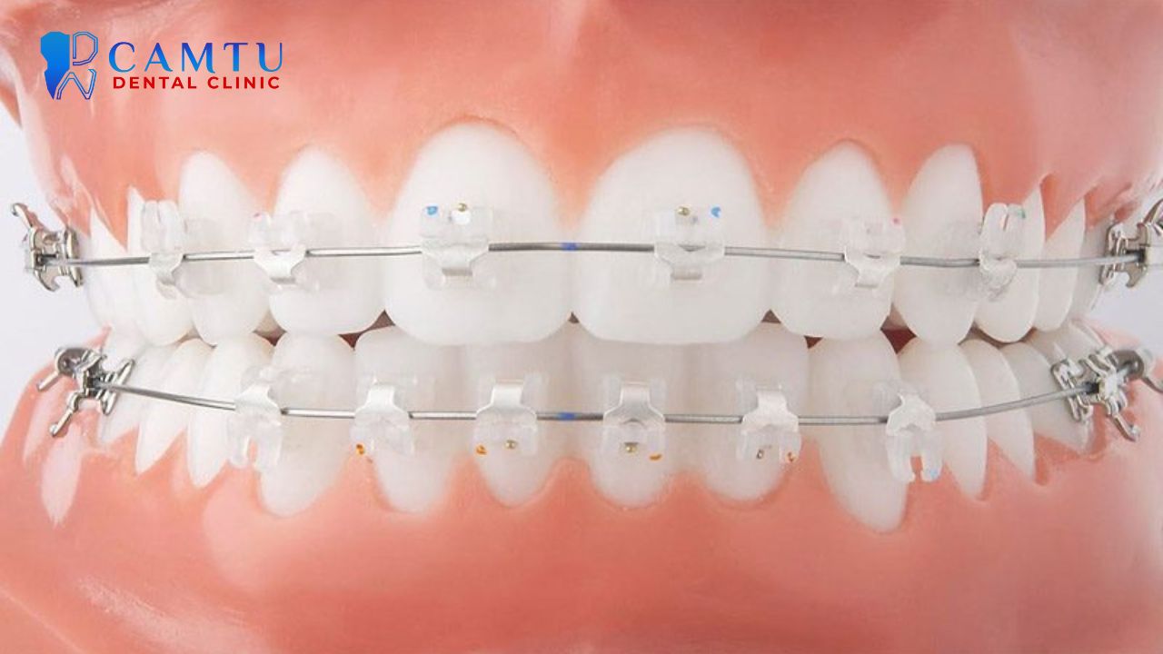 Mắc cài sứ tự buộc