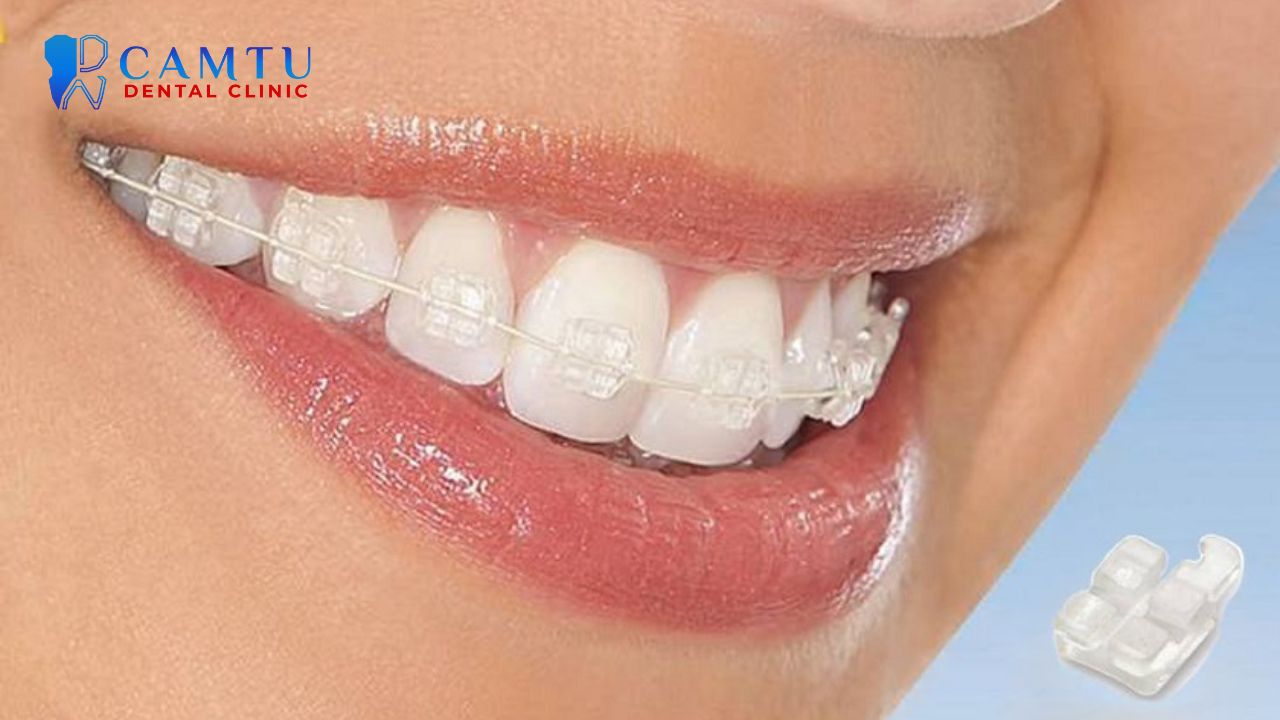 Mắc cài sứ tự buộc