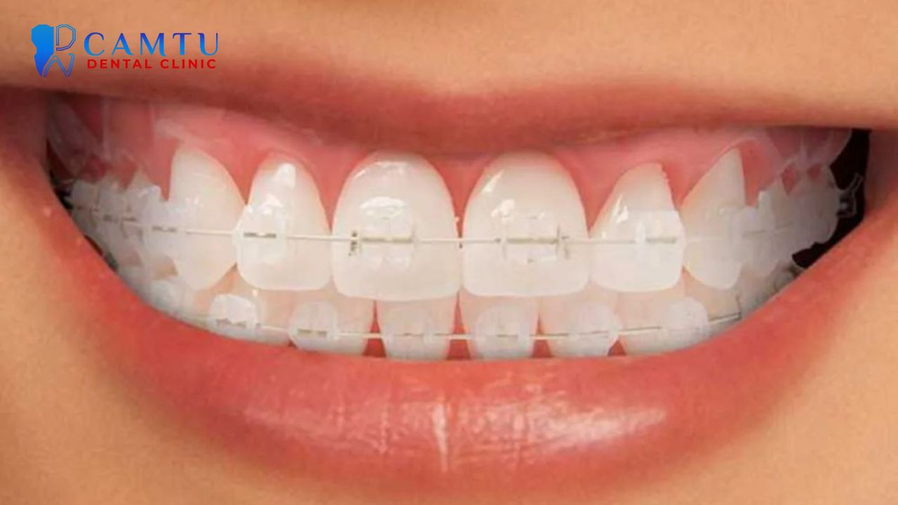 Mắc cài sứ tự buộc