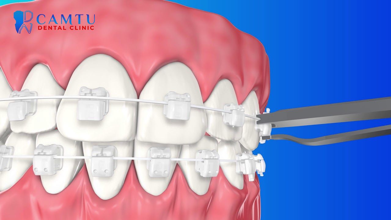 Mắc cài sứ tự buộc
