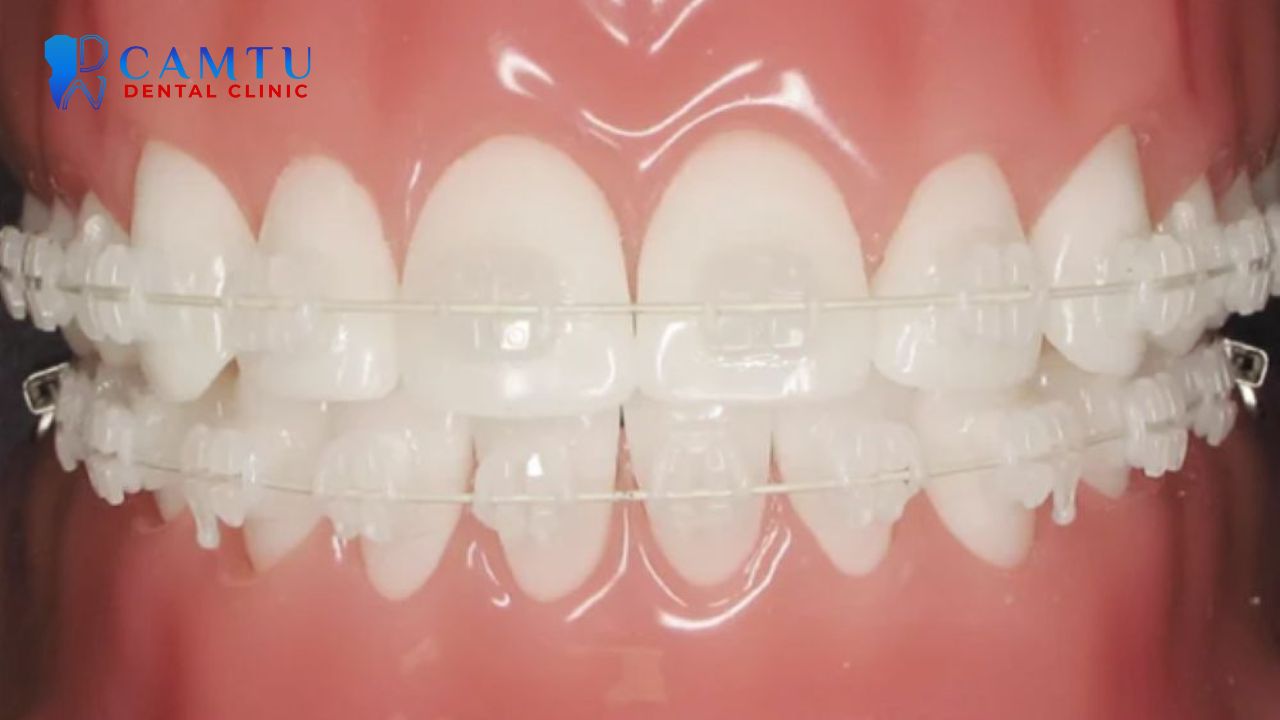 Mắc cài sứ tự buộc