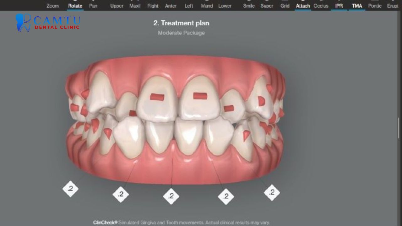 niềng răng invisalign Comprehensive 3