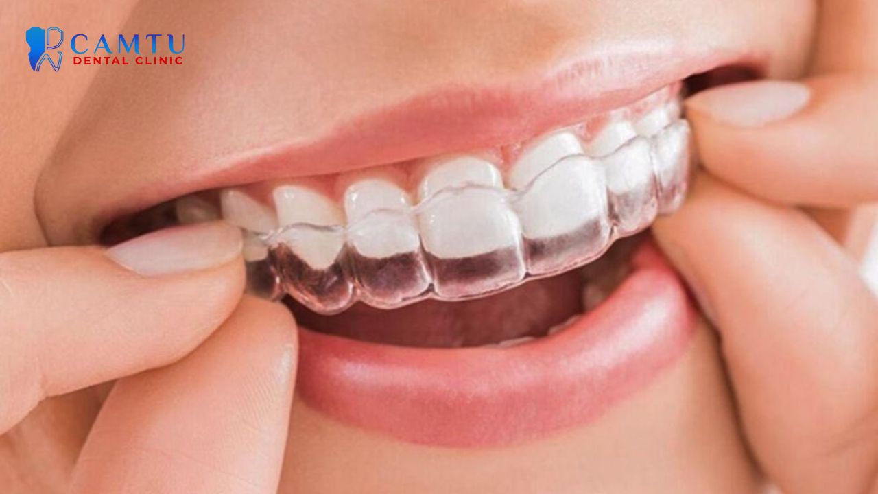 niềng răng invisalign express