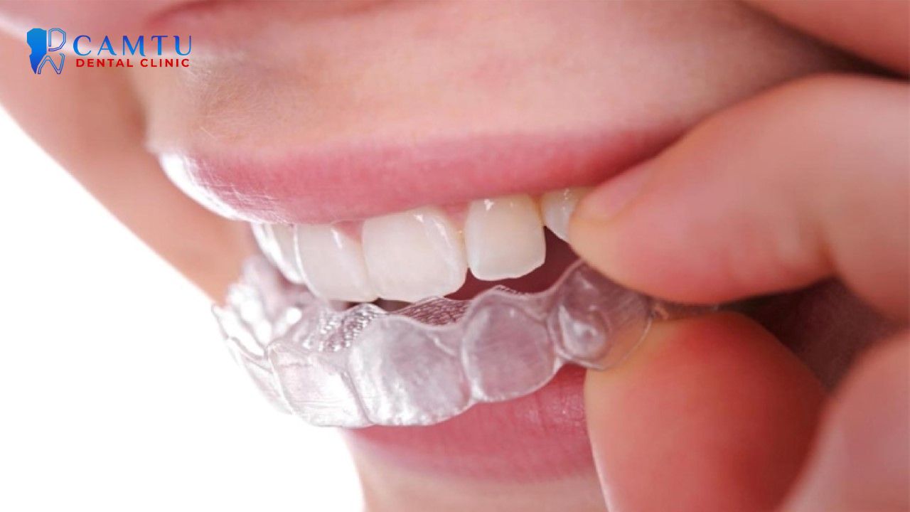 niềng răng invisalign express