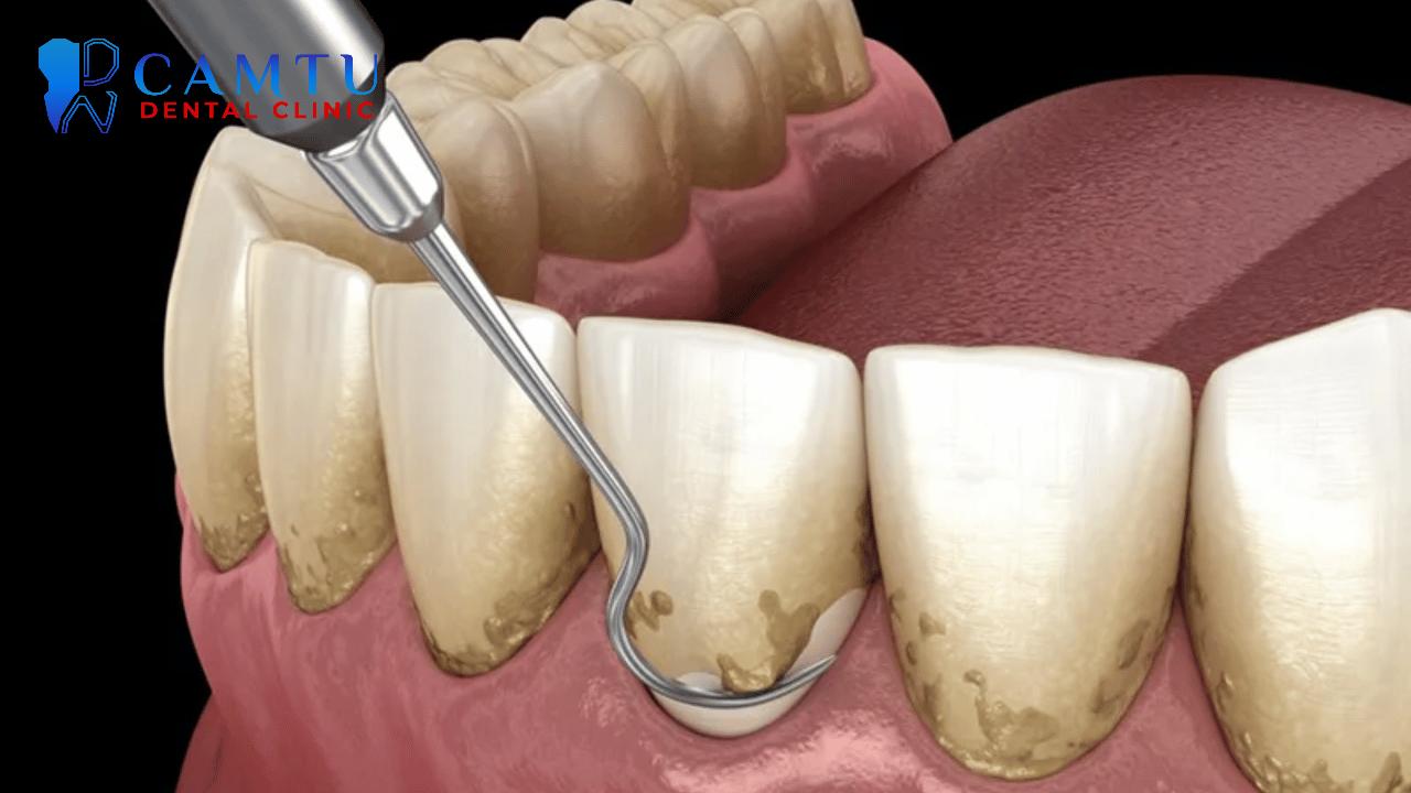 Người bệnh cần chọn phương pháp điều trị phù hợp với tình trạng răng.