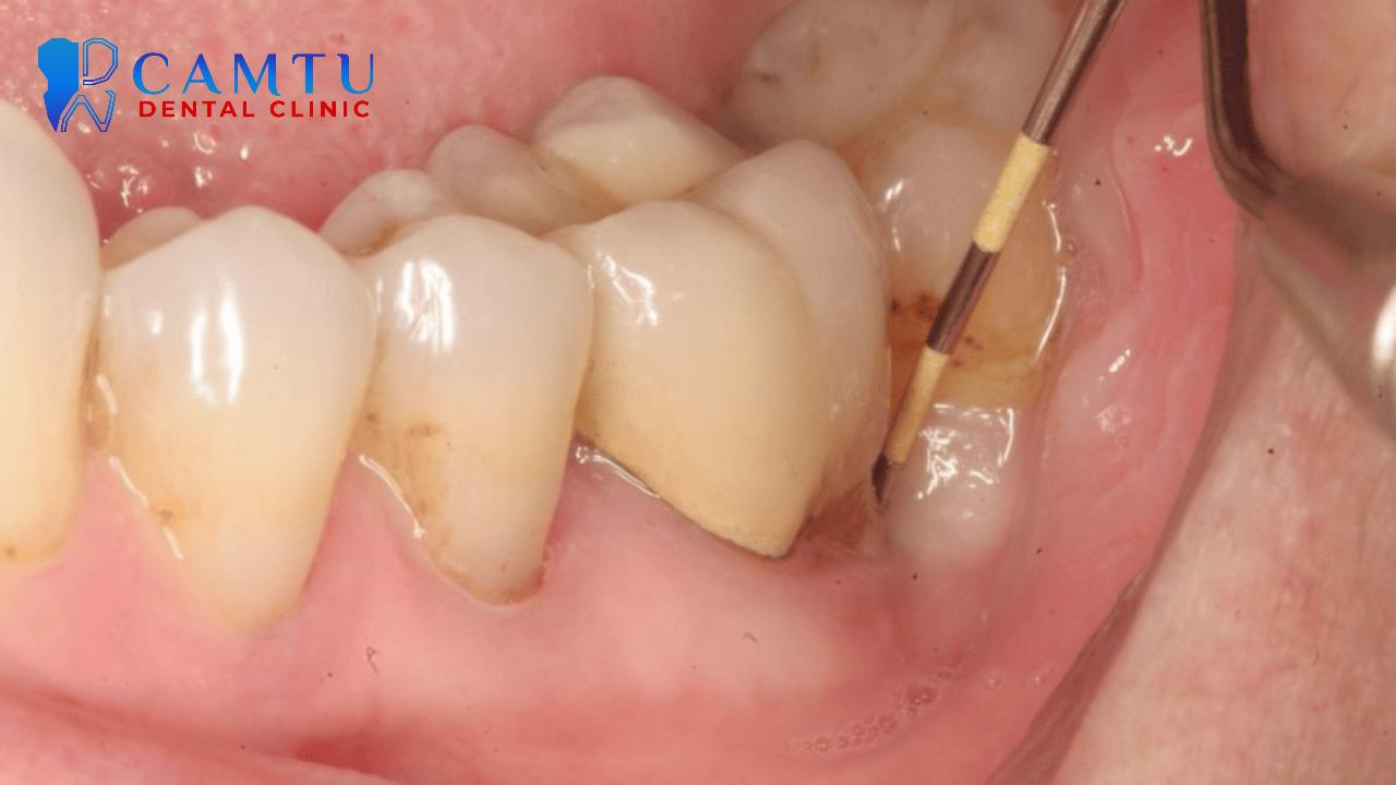 Viêm quanh răng xuất phát từ vi khuẩn tích tụ hàng ngày.