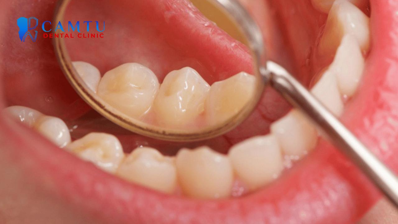 Có nhiều nguyên nhân dẫn đến viêm lợi.