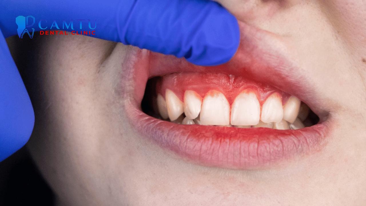 Viêm lợi có thể được nhận biết qua một vài dấu hiệu cụ thể.