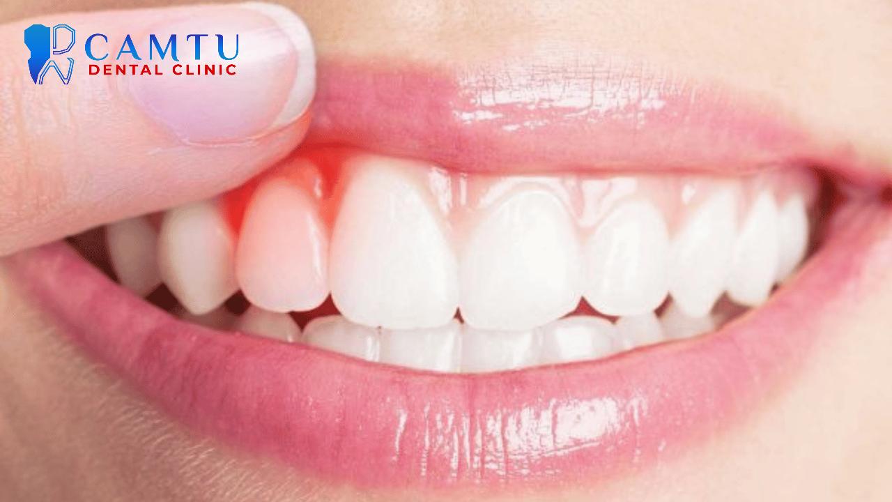 Những dấu hiệu đầu tiên của viêm quanh răng thường bị bỏ qua.