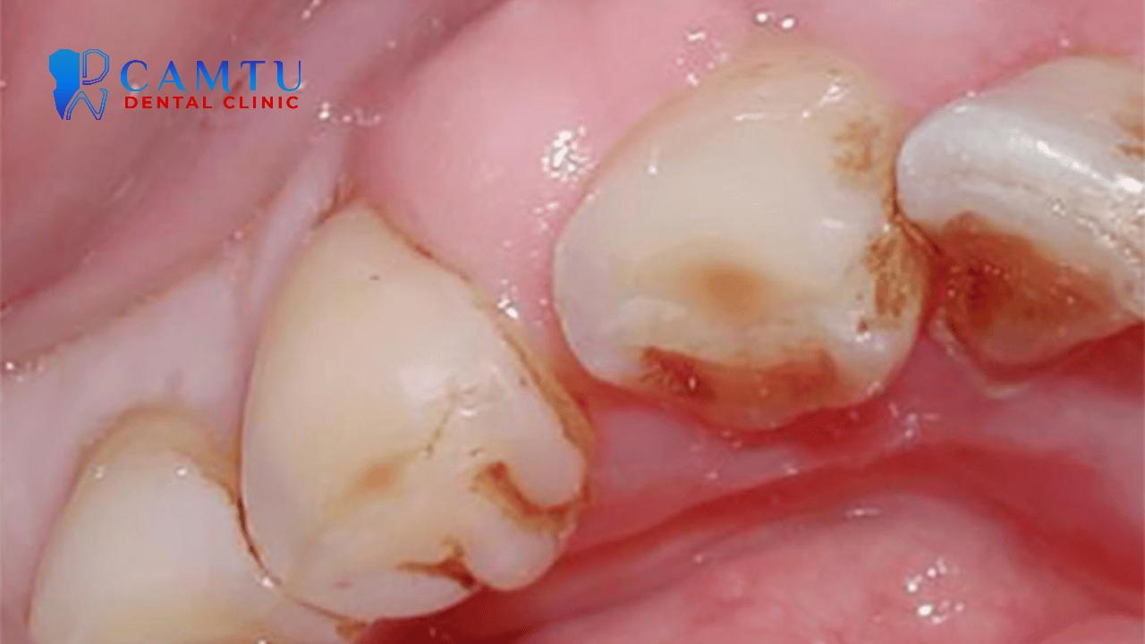 Viêm lợi có mủ là tình trạng đáng lo.