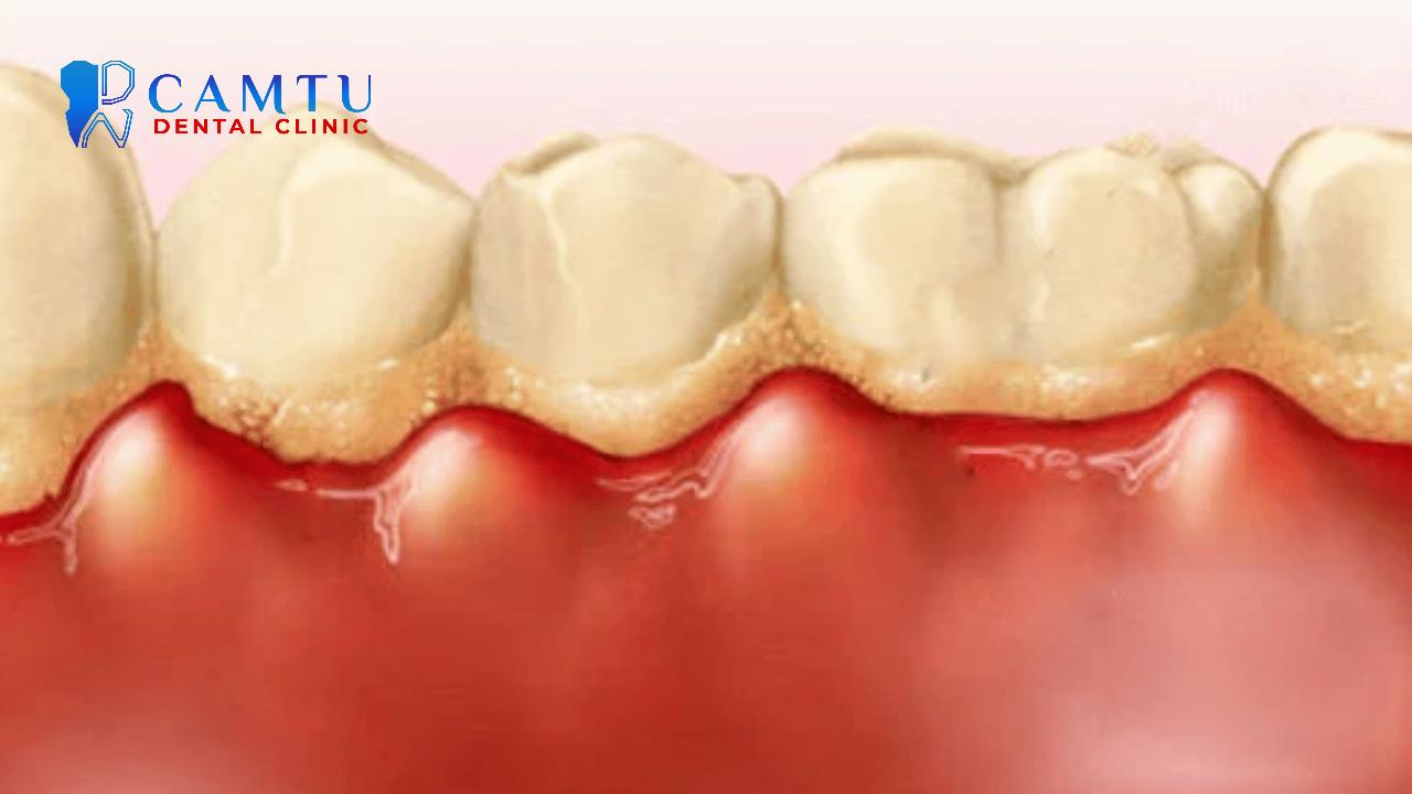 Lựa chọn phương pháp điều trị viêm lợi phù hợp với từng tình trạng.