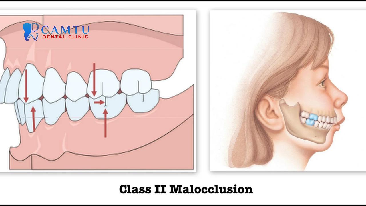 Sai khớp cắn loại 2 là vấn đề răng hàm mặt phổ biến.