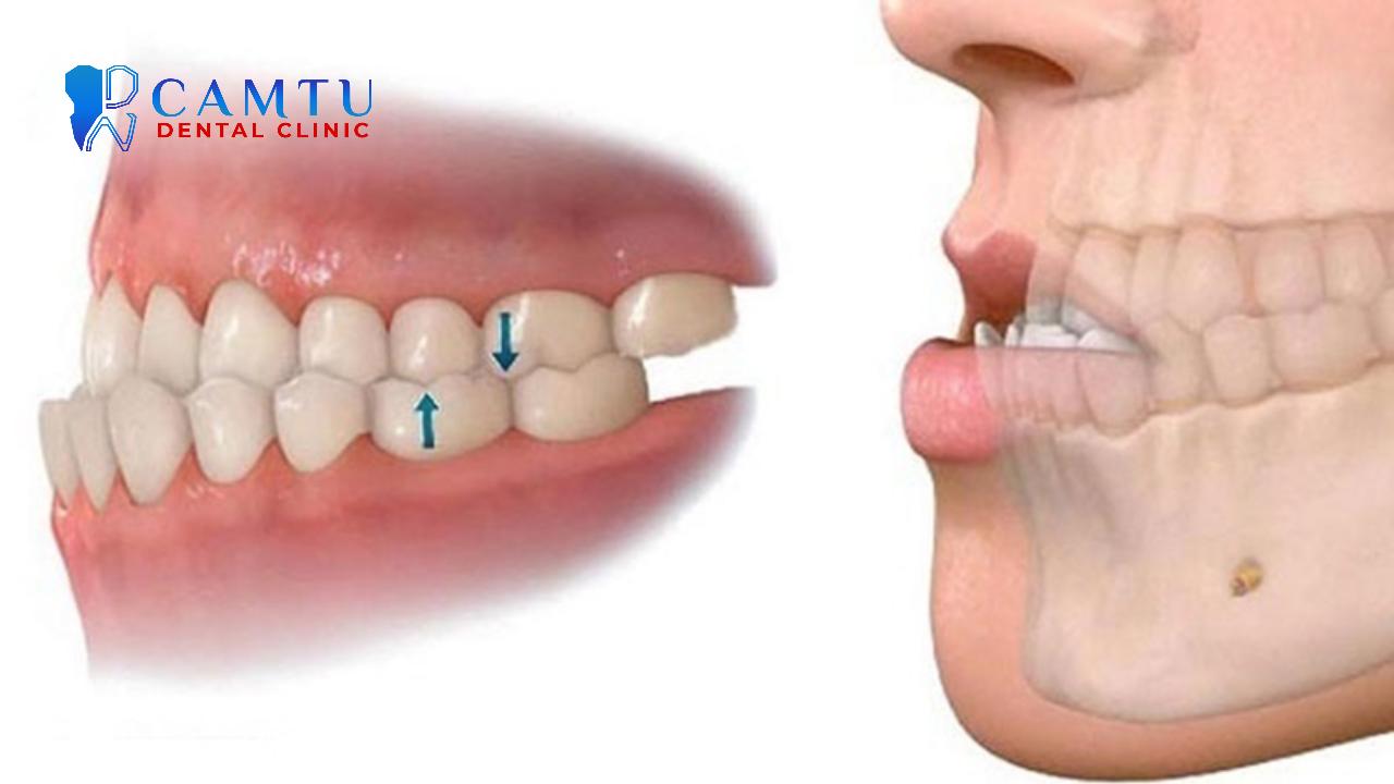 Sai khớp cắn loại 3 thường được gọi là móm.