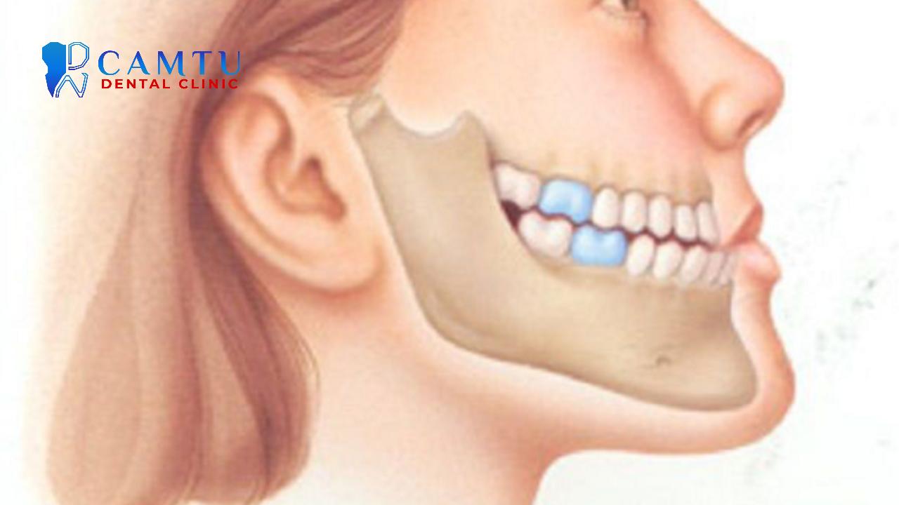 Tình trạng gương mặt nhìn nghiêng phổ biến của người mắc sai khớp cắn loại 3.