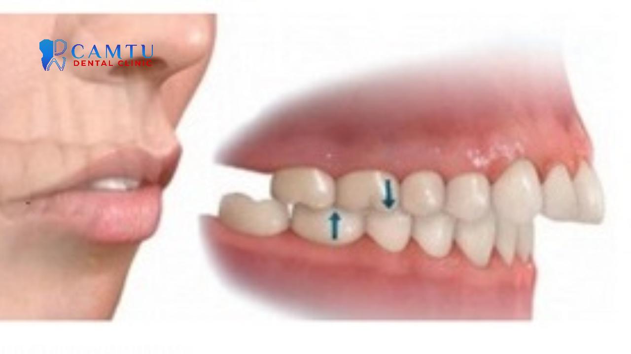 Hàm trên nhô ra rõ rệt là dấu hiệu dễ nhận biết của sai khớp cắn loại 2.