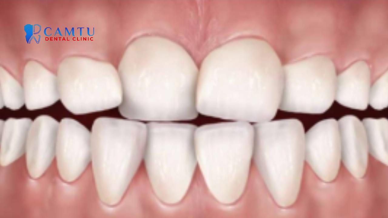 Có nhiều loại sai khớp cắn loại 2.