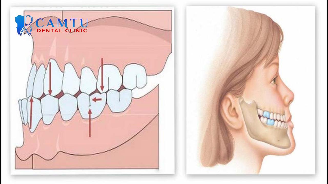 Có 2 dạng sai khớp cắn loại 3.