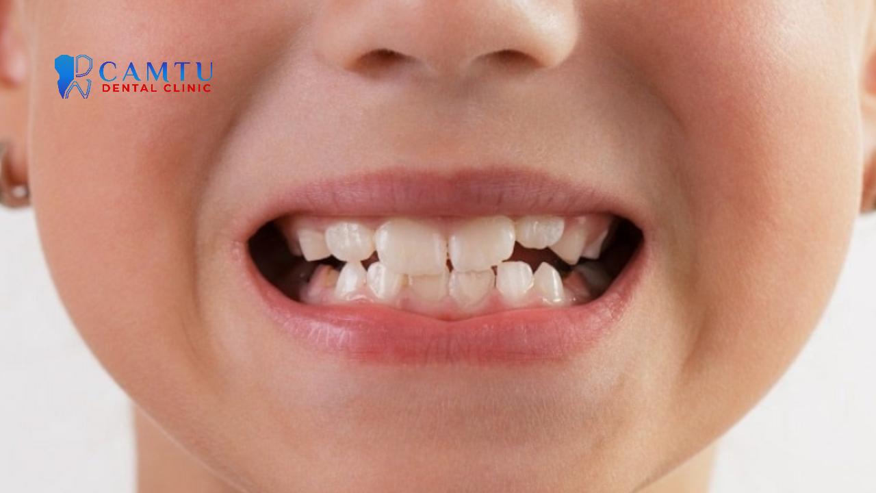 Sai khớp cắn loại 2 ảnh hưởng đến thẩm mỹ và sức khỏe.