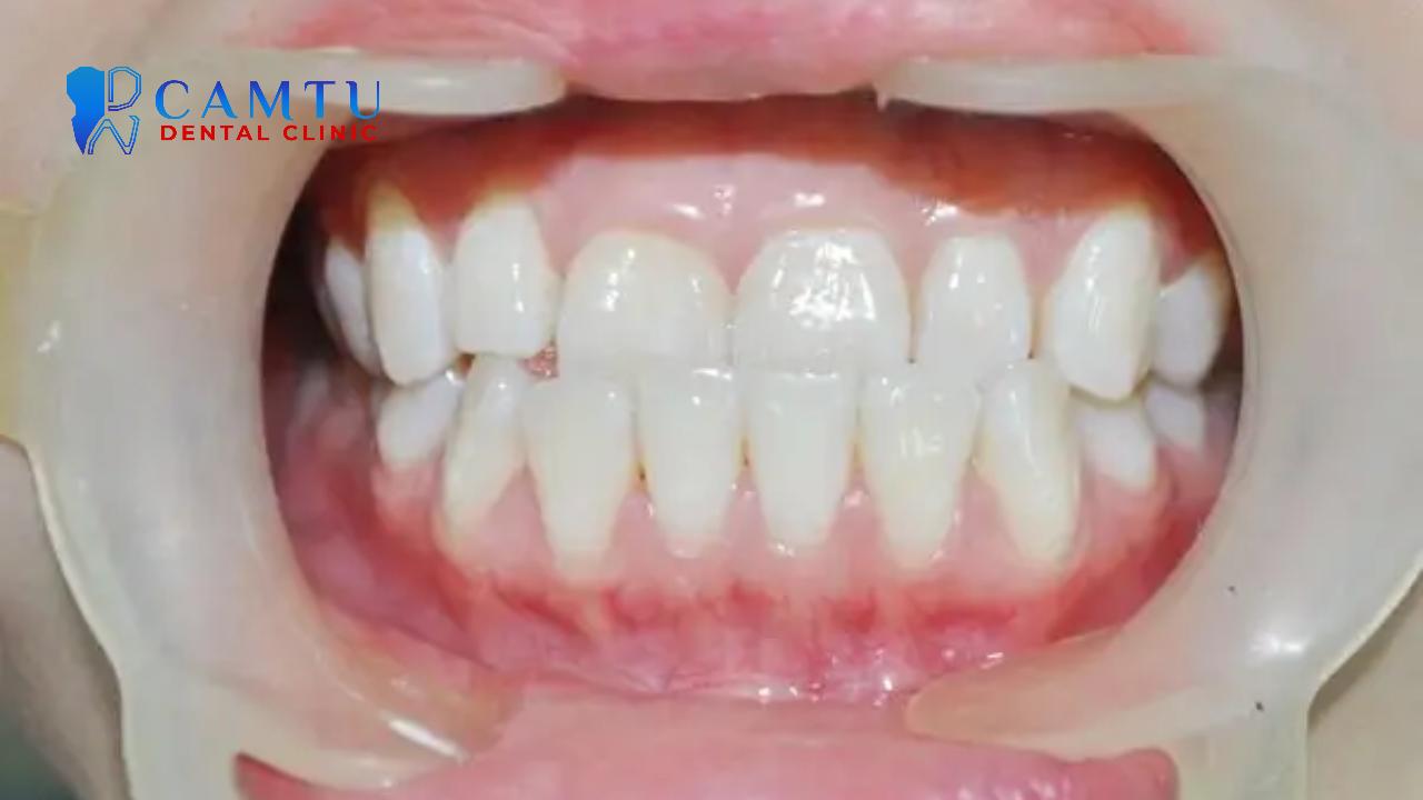 Tùy vào mức độ nặng nhẹ, người bệnh sẽ được điều trị bằng phương pháp phù hợp.