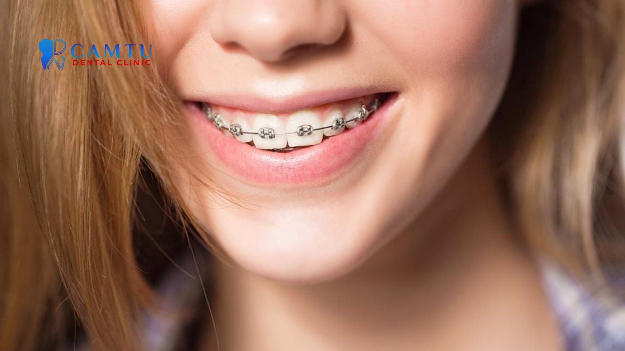 Niềng răng là một trong những phương pháp điều trị sai khớp cắn phổ biến.