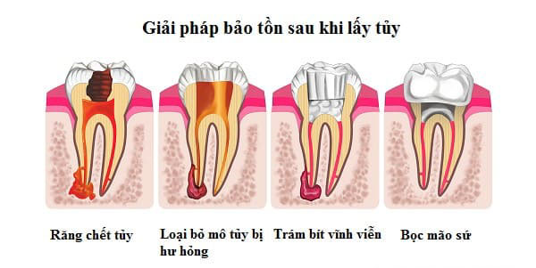 Giải pháp điều trị khi bị áp xe răng