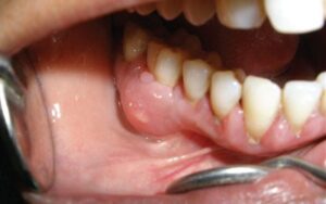 Ảnh minh họa mụn mủ ở nướu, lỗ rò